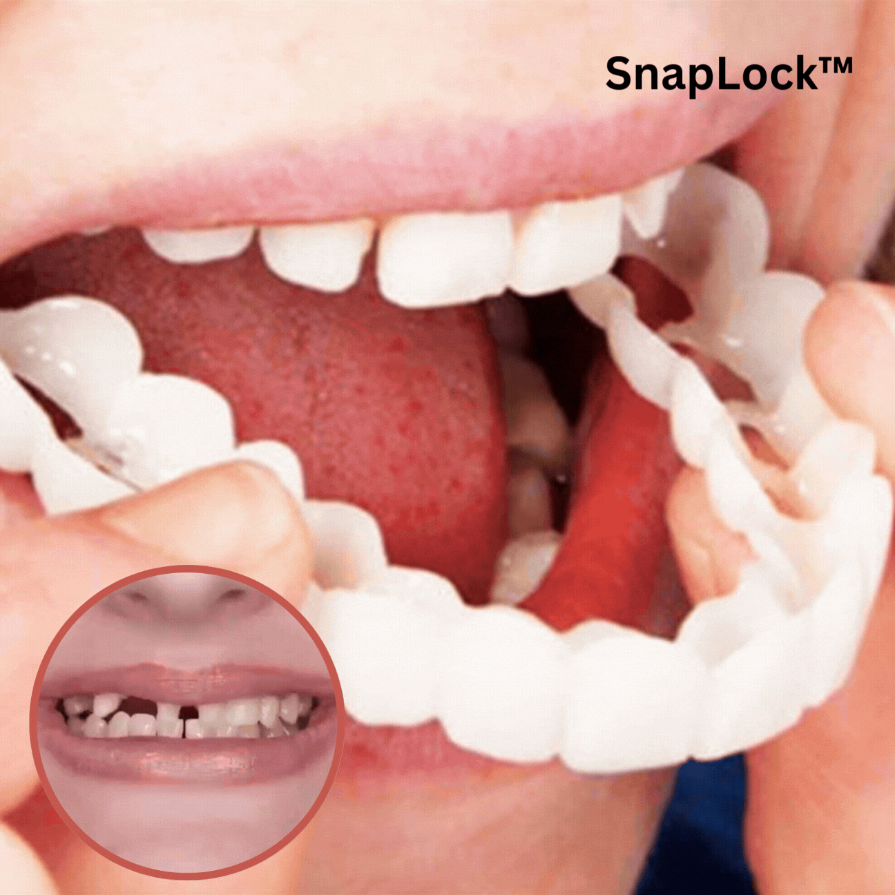 Dentadura postiza de ajuste rápido - Sonrisa perfecta