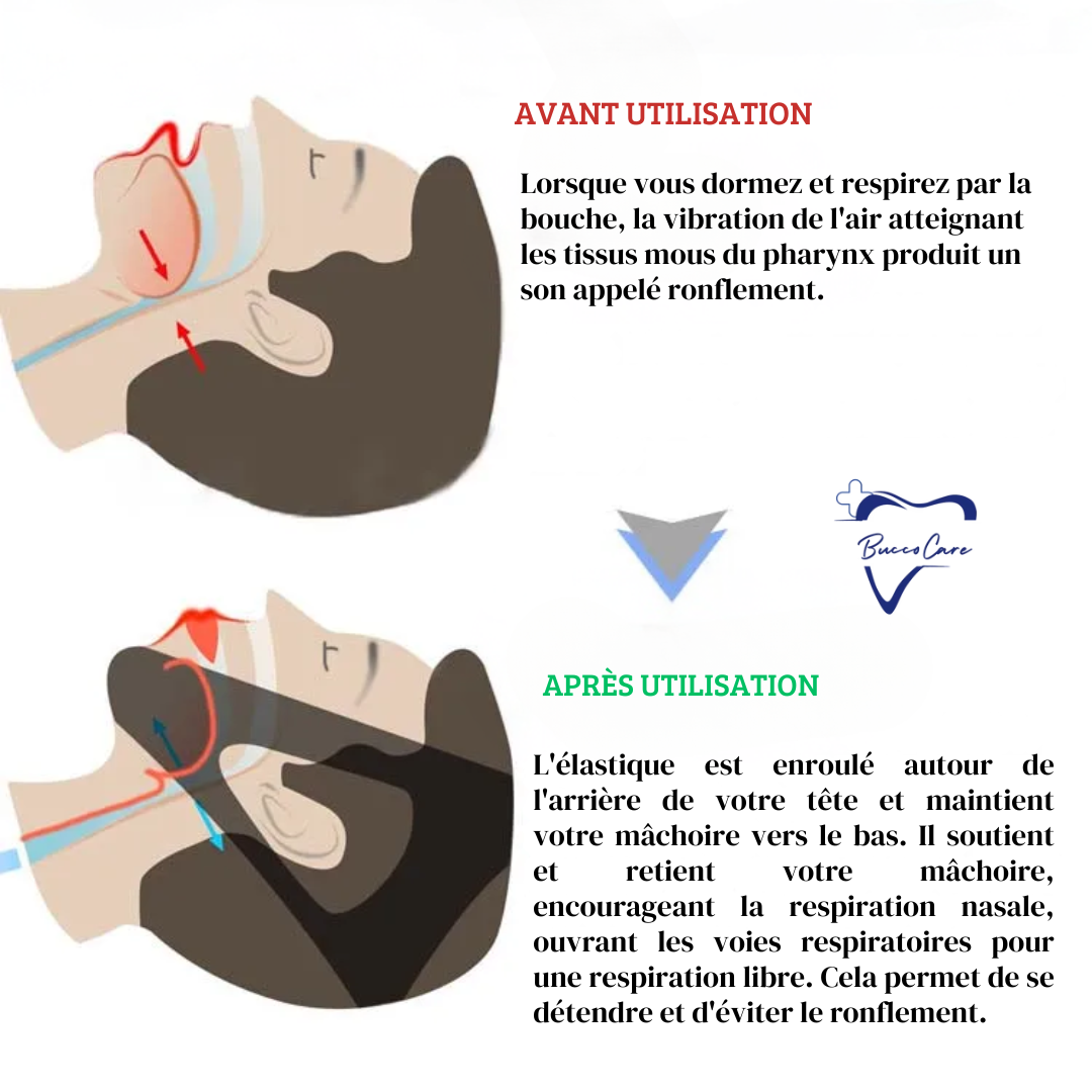 Dispositivo Antirronquidos - Apnea del Sueño - Confort Nocturno