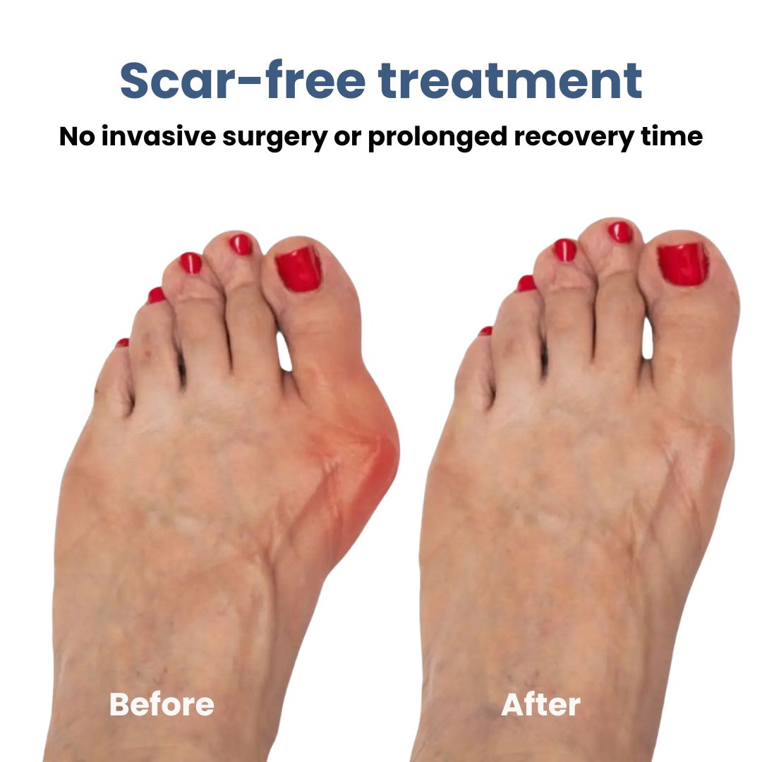 Férula Correctora para Juanetes (Hallux Valgus)