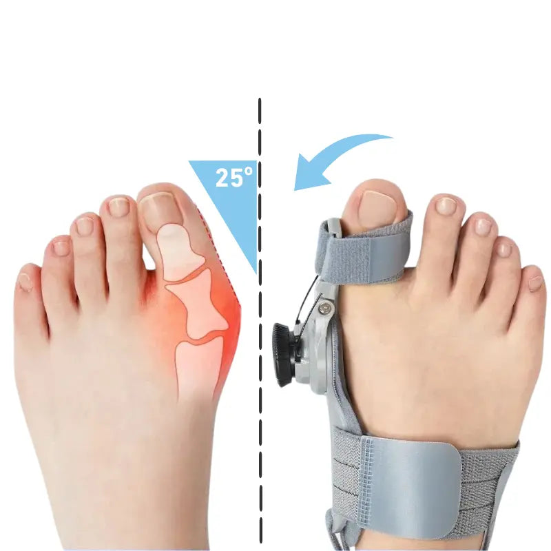 Férula Correctora para Juanetes (Hallux Valgus)