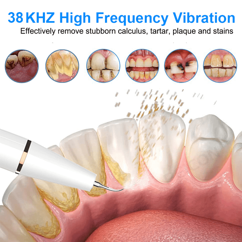 Limpiador y eliminador eléctrico ultrasónico de sarro dental