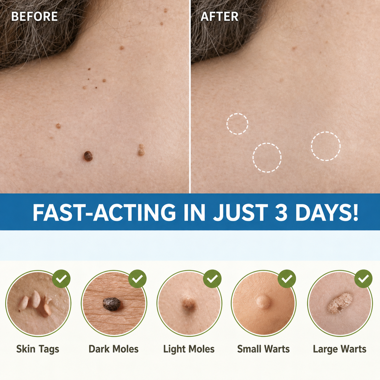 Parches eliminadores de imperfecciones cutáneas | Indoloro y natural